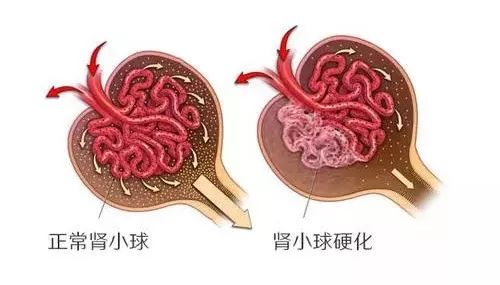 蛋白尿是怎麼回事？當心5種腎病！專家教你2道養腎菜 健康 第3張