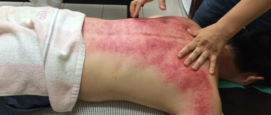 百治不如一刮！10种刮痧法，刮走全身疾病，用勺子就能做，不看亏了~