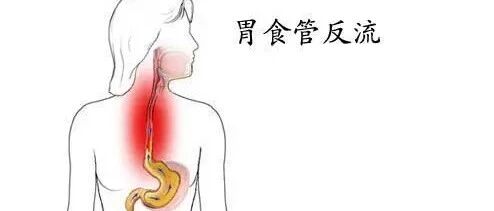 经常反酸、烧心？小心这毛病！一篇文章帮你搞定