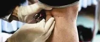 这些疾病，放一点点血，就化解了！（24种疑难杂症的刺血疗法）