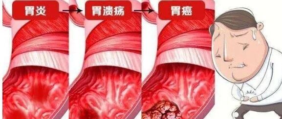 胃溃疡久治不愈？这几种食物坚持吃