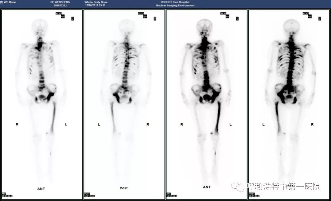 呼和浩特市第一医院核医学科 骨扫描 病例分享 呼和浩特市第一医院 微信公众号文章阅读 Wemp
