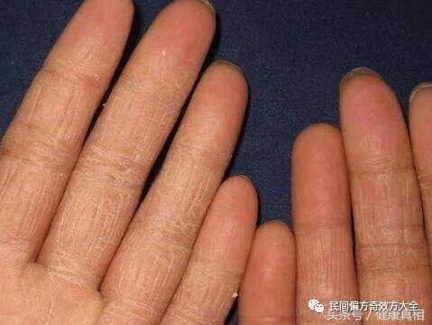 治疗手足癣的一个有效偏方，不花钱不遭罪