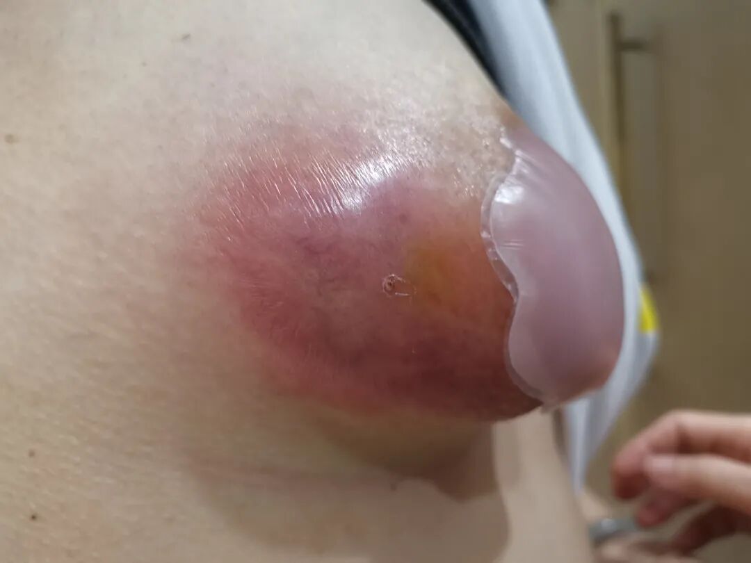中药调理好了我的乳腺炎和闭经四年的例假