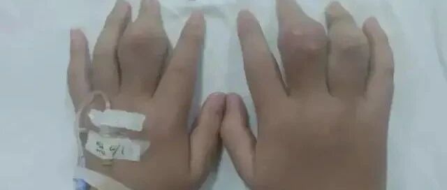 12岁男孩活活吃出痛风，最终截肢...家长悔恨万分！“罪魁祸首”竟是餐桌上的它