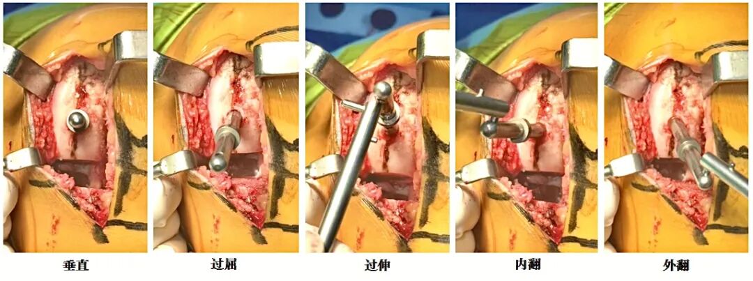 【滑动垫片单髁置换技术精讲系列】第三期：股骨截骨