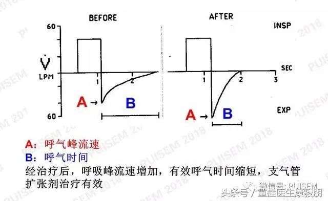 呼吸机f指什么常见呼吸机波形！_https://www.jmylbn.com_新闻资讯_第10张