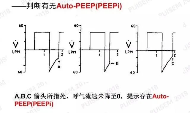 呼吸机f指什么常见呼吸机波形！_https://www.jmylbn.com_新闻资讯_第12张