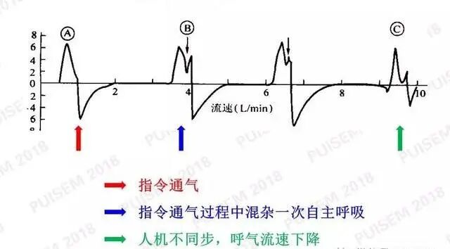 呼吸机f指什么常见呼吸机波形！_https://www.jmylbn.com_新闻资讯_第8张