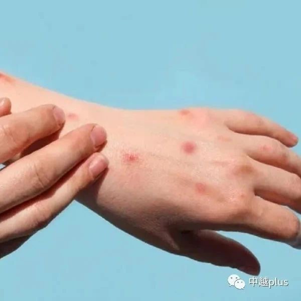 东南亚国家出现猴痘疫情，越南探讨应对猴痘的措施