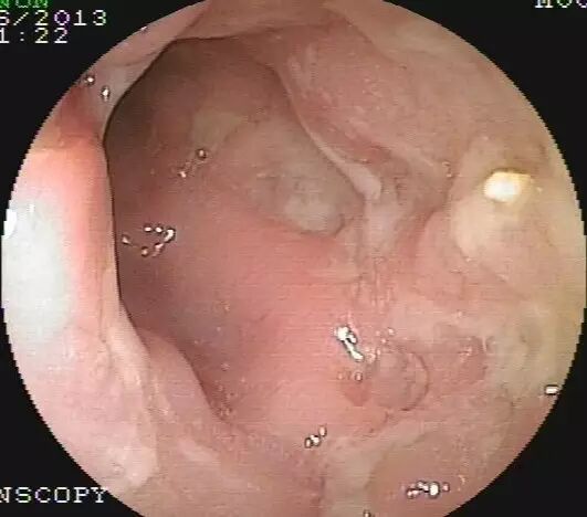 有下消化道症状,如慢性腹泻,长期便秘,腹痛,腹胀等诊断不明确者 3.