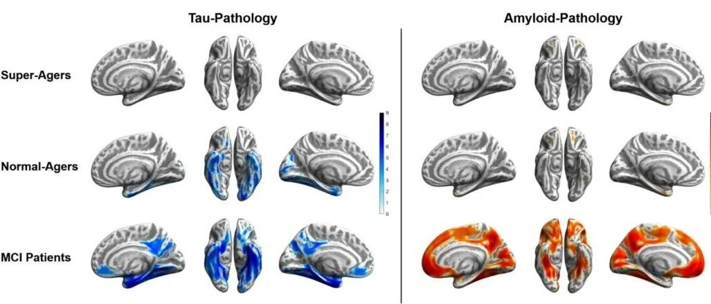 “超级老人”的大脑为何能抵御阿尔茨海默病