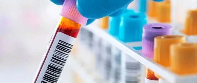 血液测试可能成为阿尔茨海默病的诊断工具