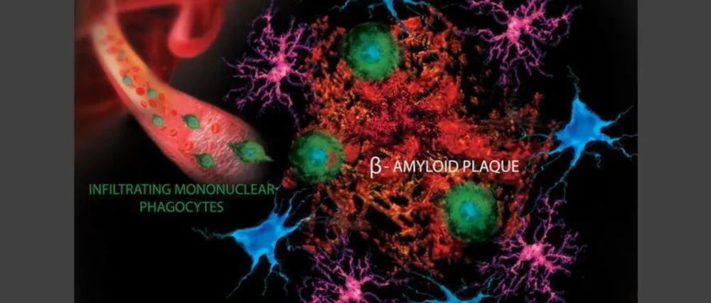 大脑中的血管渗漏是阿尔茨海默病的罪魁祸首吗？