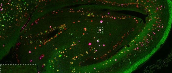 阿尔茨海默病：基于突触改变的另一种假说