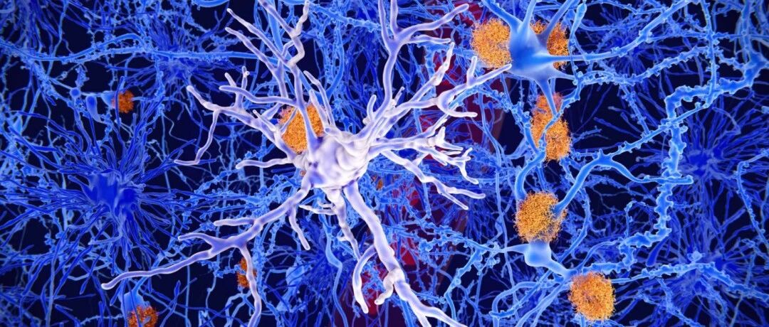 脑中过度活跃的细胞如何引发阿尔茨海默病