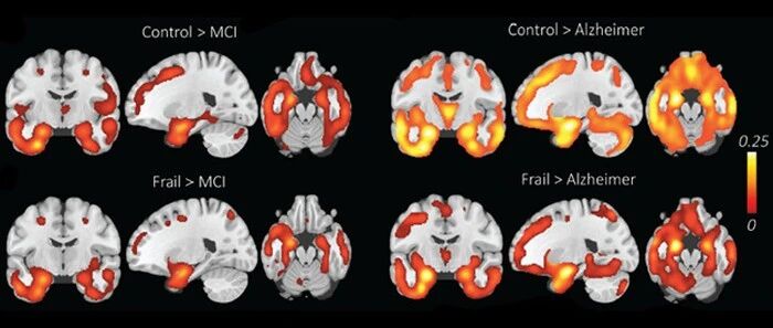 认知能力下降并不总是阿尔茨海默病的征兆