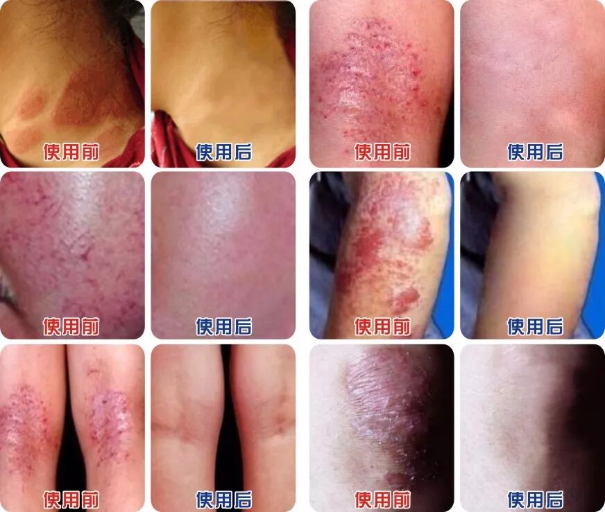 痒得睡不着 那是神经性皮炎 肤康堂皮肤健康 微信公众号文章阅读 Wemp