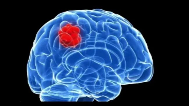 脑电图仪器是什么样子最新人脑检测仪器--脑磁图_https://www.jmylbn.com_新闻资讯_第5张