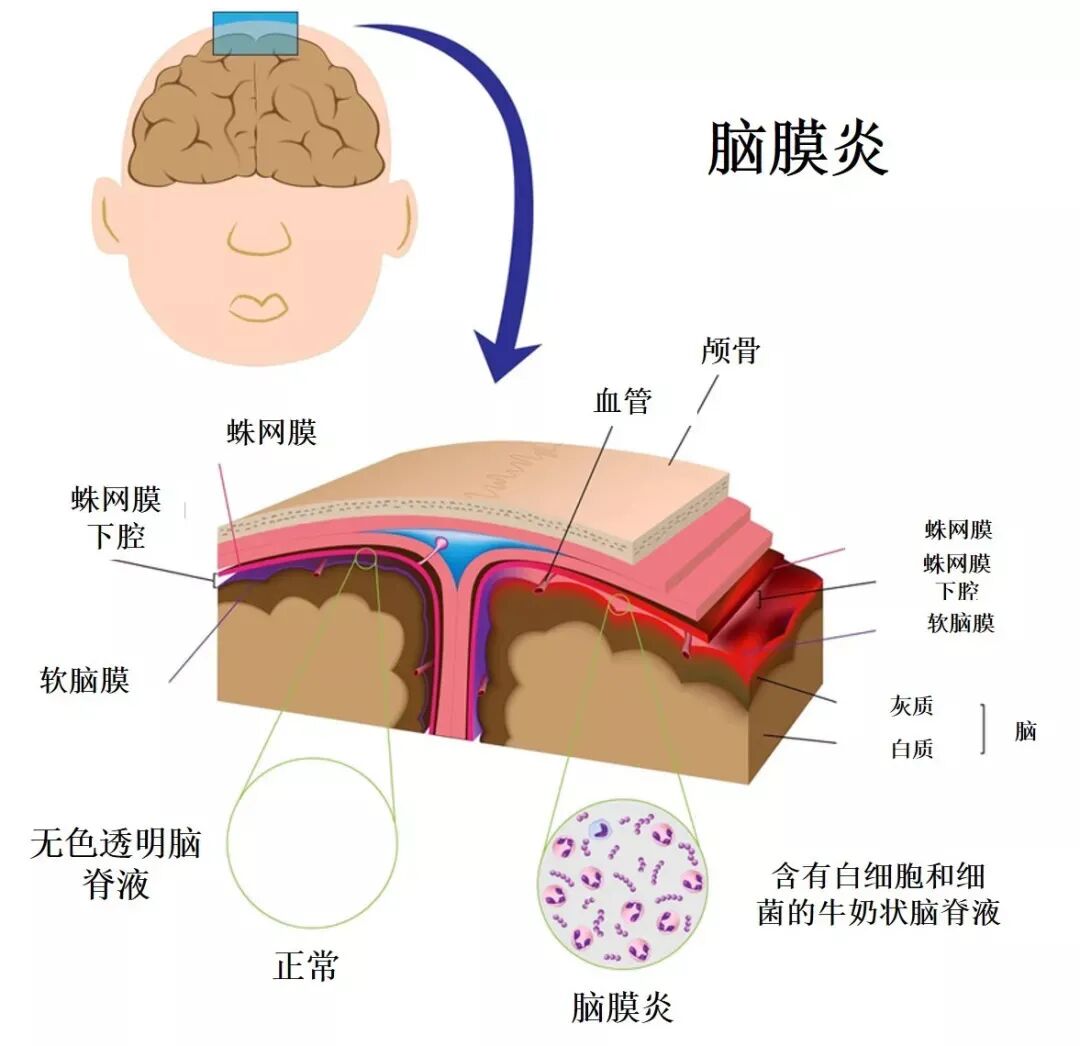 流行性脑脊髓膜炎简称流脑,它是由脑膜炎双球菌引起的急性呼吸道传染