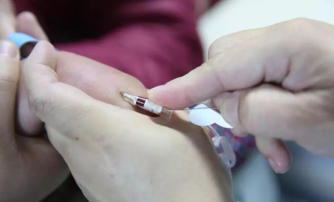 留置针怎么单手推针留置针单手送管法，提高成功率，你get了吗？(内附视频)_https://www.jmylbn.com_新闻资讯_第4张