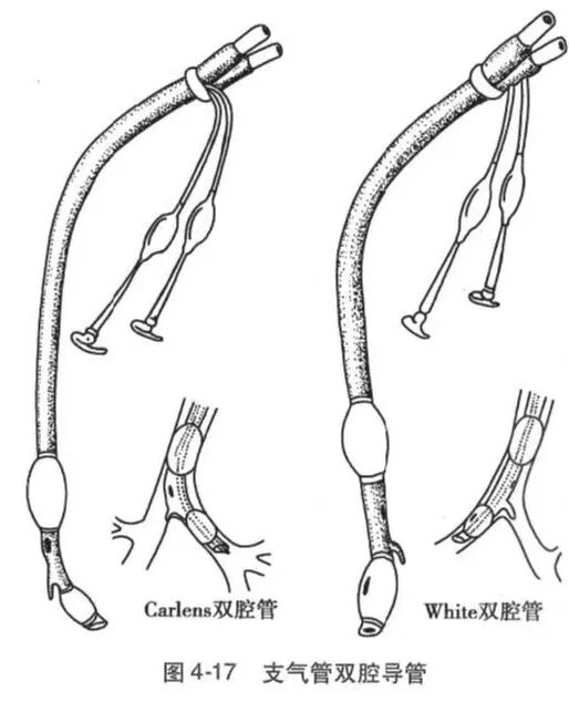 双腔气管插管怎么用第四章—第三节   支气管内插管_https://www.jmylbn.com_新闻资讯_第4张