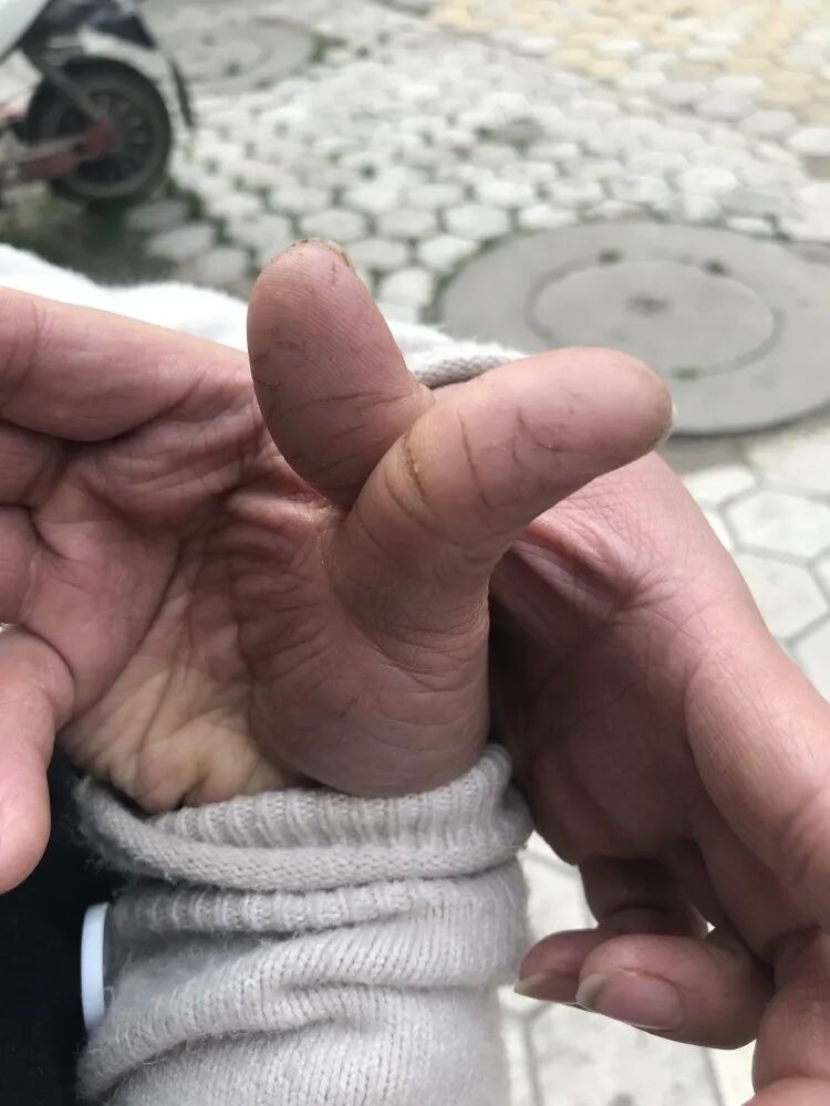 通知！石家庄已近1个小孩Saverdun！全省数处多发！(图5)