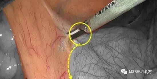 为什么手术用电刀电刀与超声刀在胸外科手术中的应用与比较_https://www.jmylbn.com_新闻资讯_第2张