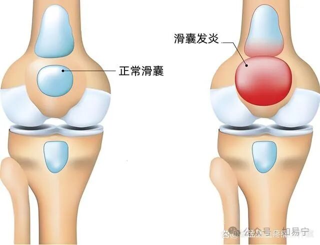 滑膜炎膝盖积水最佳治疗方法，仅靠这个方法就能轻松解决！