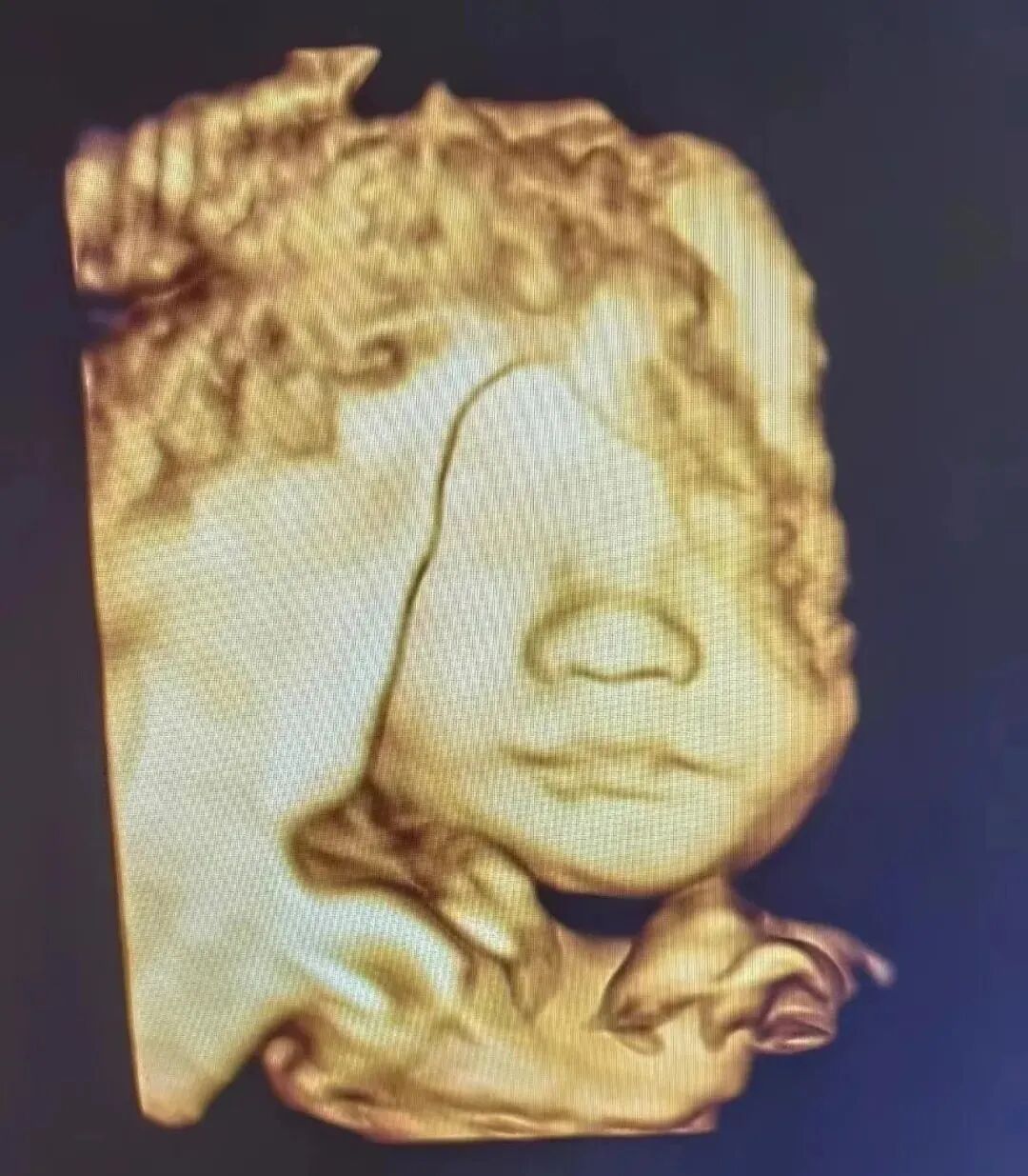 什么是超声容积探头【产检攻略】四维彩超检查，您了解多少？_https://www.jmylbn.com_新闻资讯_第12张