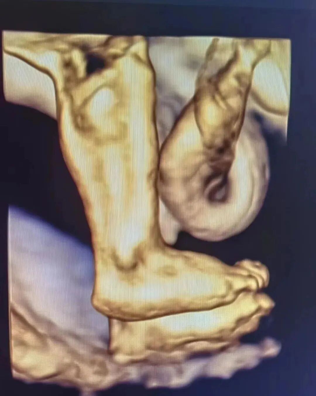 什么是超声容积探头【产检攻略】四维彩超检查，您了解多少？_https://www.jmylbn.com_新闻资讯_第13张