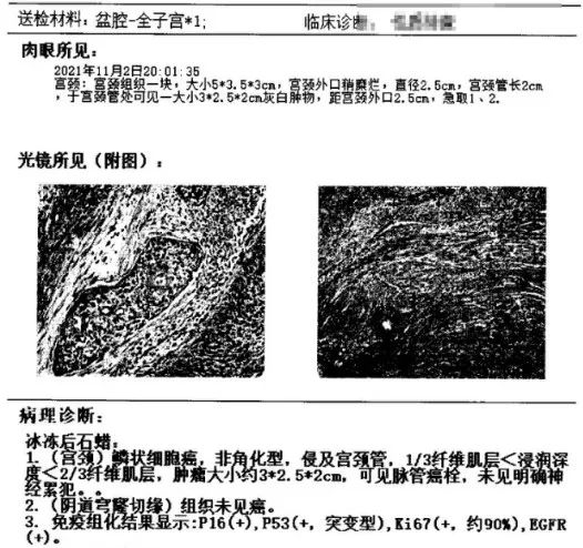 『安e术』——子宫颈癌残端广泛手术（剪辑版）