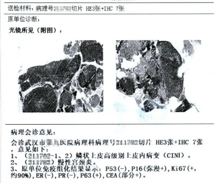 『安e术』——子宫颈癌残端广泛手术（剪辑版）