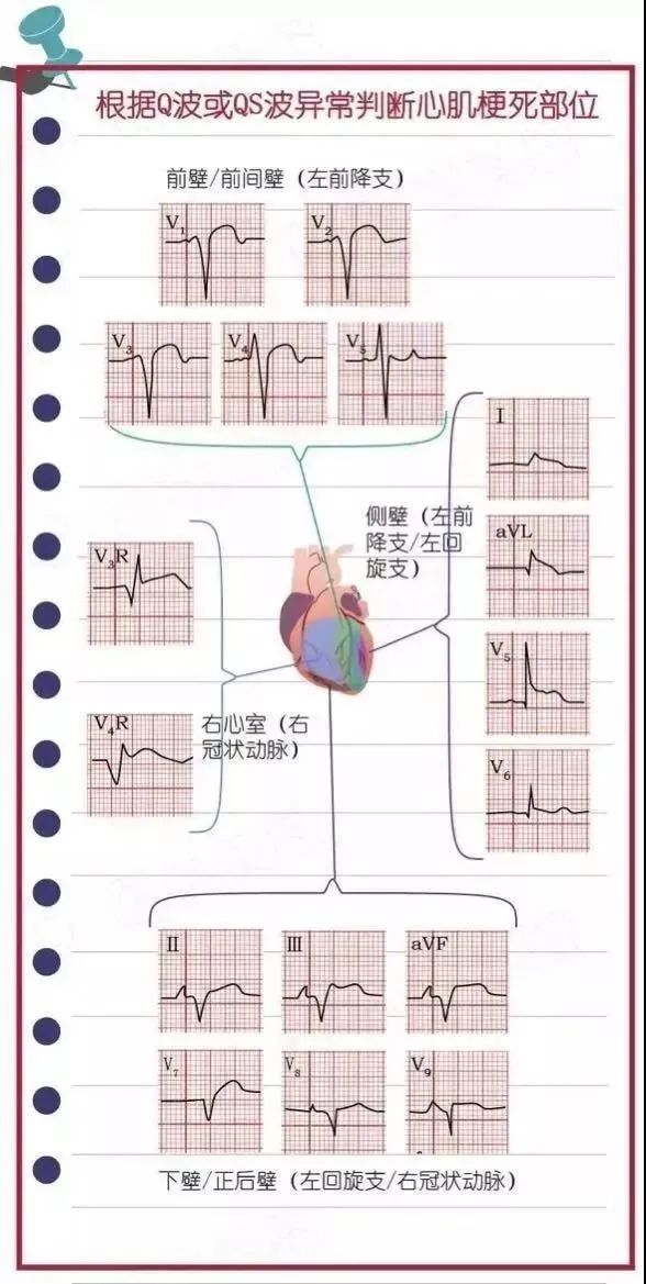 急性心肌梗死如何快速高效急救？