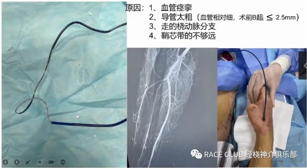 桡动脉鞘怎么读何爽教授：经桡动脉神经介入诊治的困难及并发症_https://www.jmylbn.com_新闻资讯_第16张