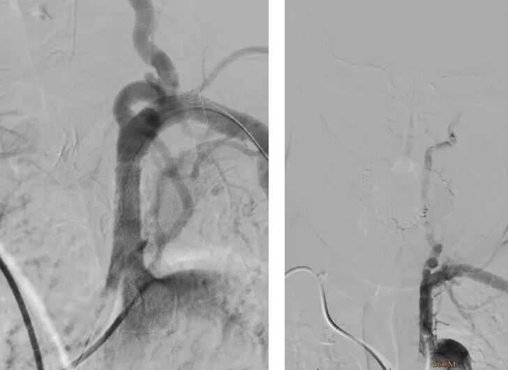 桡动脉鞘怎么读【REPLAY·周三全桡日】王鹏：双侧桡动脉入路 锁骨下支架_https://www.jmylbn.com_新闻资讯_第18张