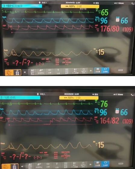 桡动脉鞘怎么读【REPLAY·周三全桡日】王鹏：双侧桡动脉入路 锁骨下支架_https://www.jmylbn.com_新闻资讯_第14张
