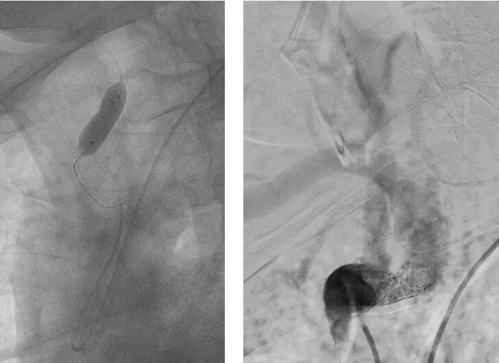 桡动脉鞘怎么读【REPLAY·周三全桡日】王鹏：双侧桡动脉入路 锁骨下支架_https://www.jmylbn.com_新闻资讯_第12张