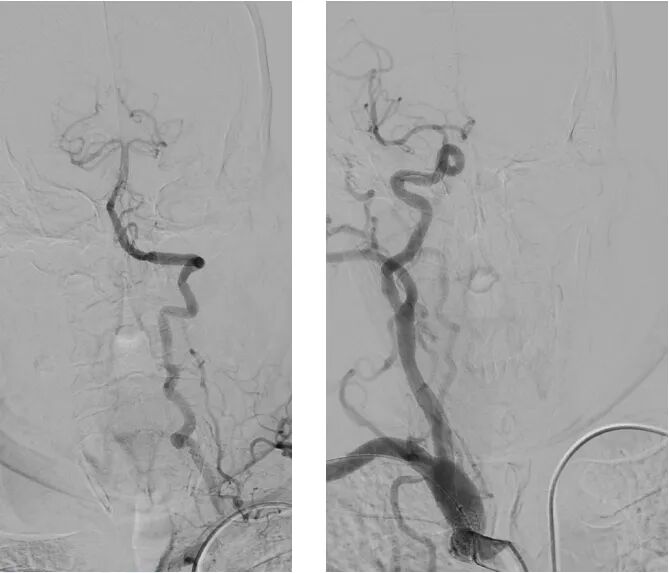 桡动脉鞘怎么读【REPLAY·周三全桡日】王鹏：双侧桡动脉入路 锁骨下支架_https://www.jmylbn.com_新闻资讯_第13张