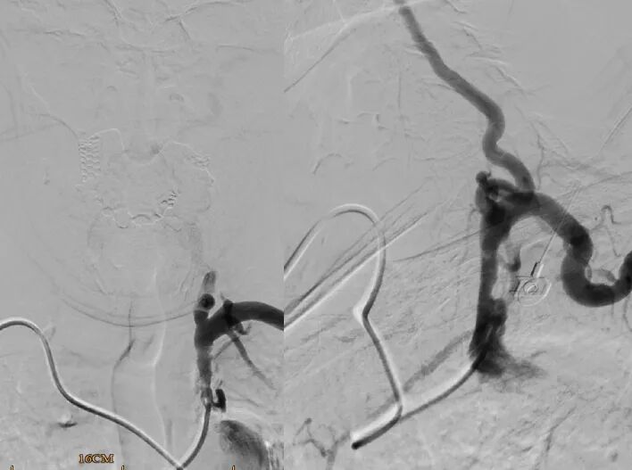桡动脉鞘怎么读【REPLAY·周三全桡日】王鹏：双侧桡动脉入路 锁骨下支架_https://www.jmylbn.com_新闻资讯_第17张