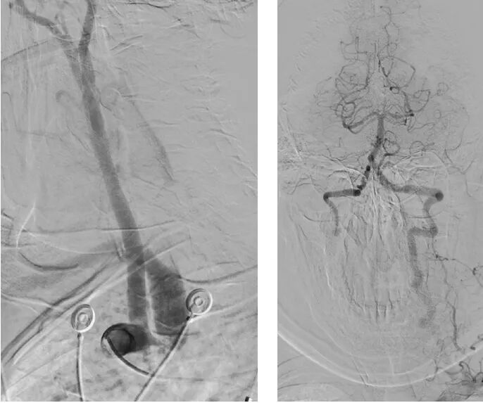 桡动脉鞘怎么读【REPLAY·周三全桡日】王鹏：双侧桡动脉入路 锁骨下支架_https://www.jmylbn.com_新闻资讯_第9张