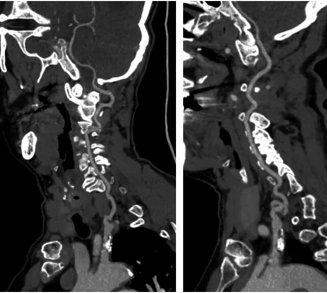 桡动脉鞘怎么读【REPLAY·周三全桡日】王鹏：双侧桡动脉入路 锁骨下支架_https://www.jmylbn.com_新闻资讯_第16张