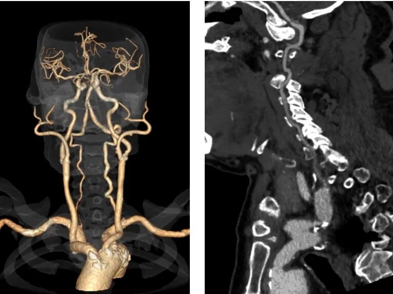 桡动脉鞘怎么读【REPLAY·周三全桡日】王鹏：双侧桡动脉入路 锁骨下支架_https://www.jmylbn.com_新闻资讯_第8张