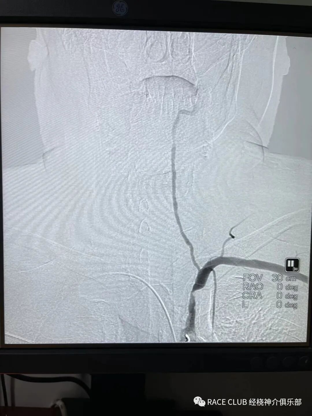 怎么上穿刺鞘RACE CLUB 实录6：Q：经桡造影或治疗，穿刺鞘如何选择？_https://www.jmylbn.com_新闻资讯_第71张