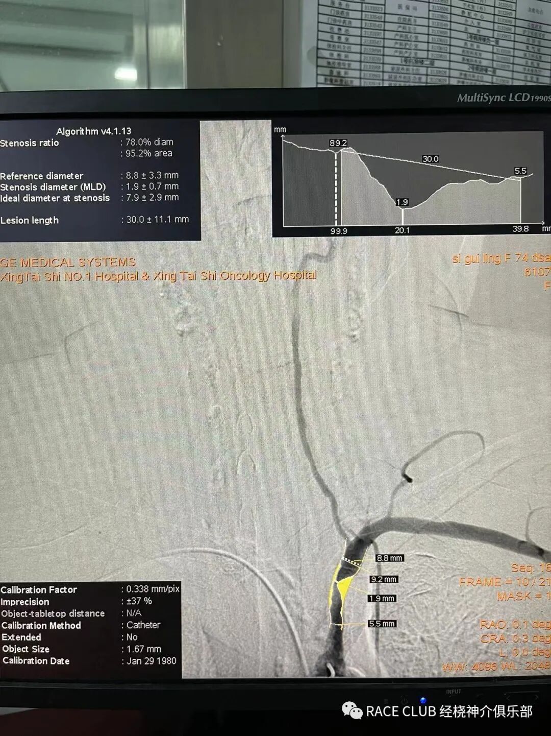 怎么上穿刺鞘RACE CLUB 实录6：Q：经桡造影或治疗，穿刺鞘如何选择？_https://www.jmylbn.com_新闻资讯_第69张