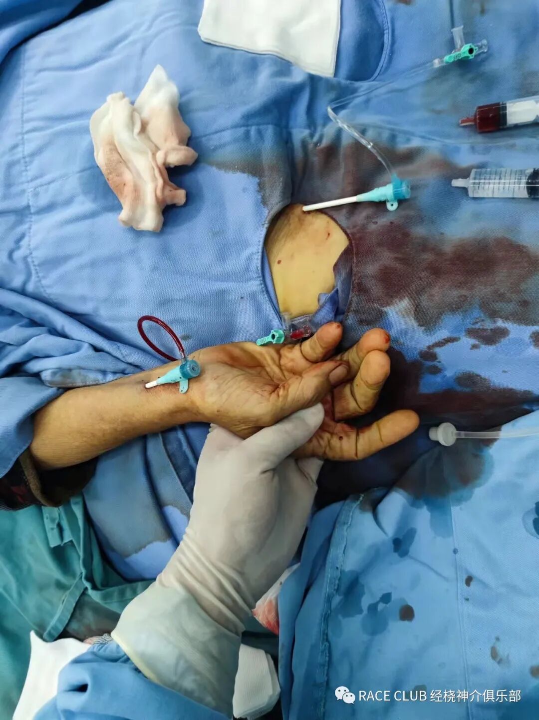 怎么上穿刺鞘RACE CLUB 实录6：Q：经桡造影或治疗，穿刺鞘如何选择？_https://www.jmylbn.com_新闻资讯_第34张