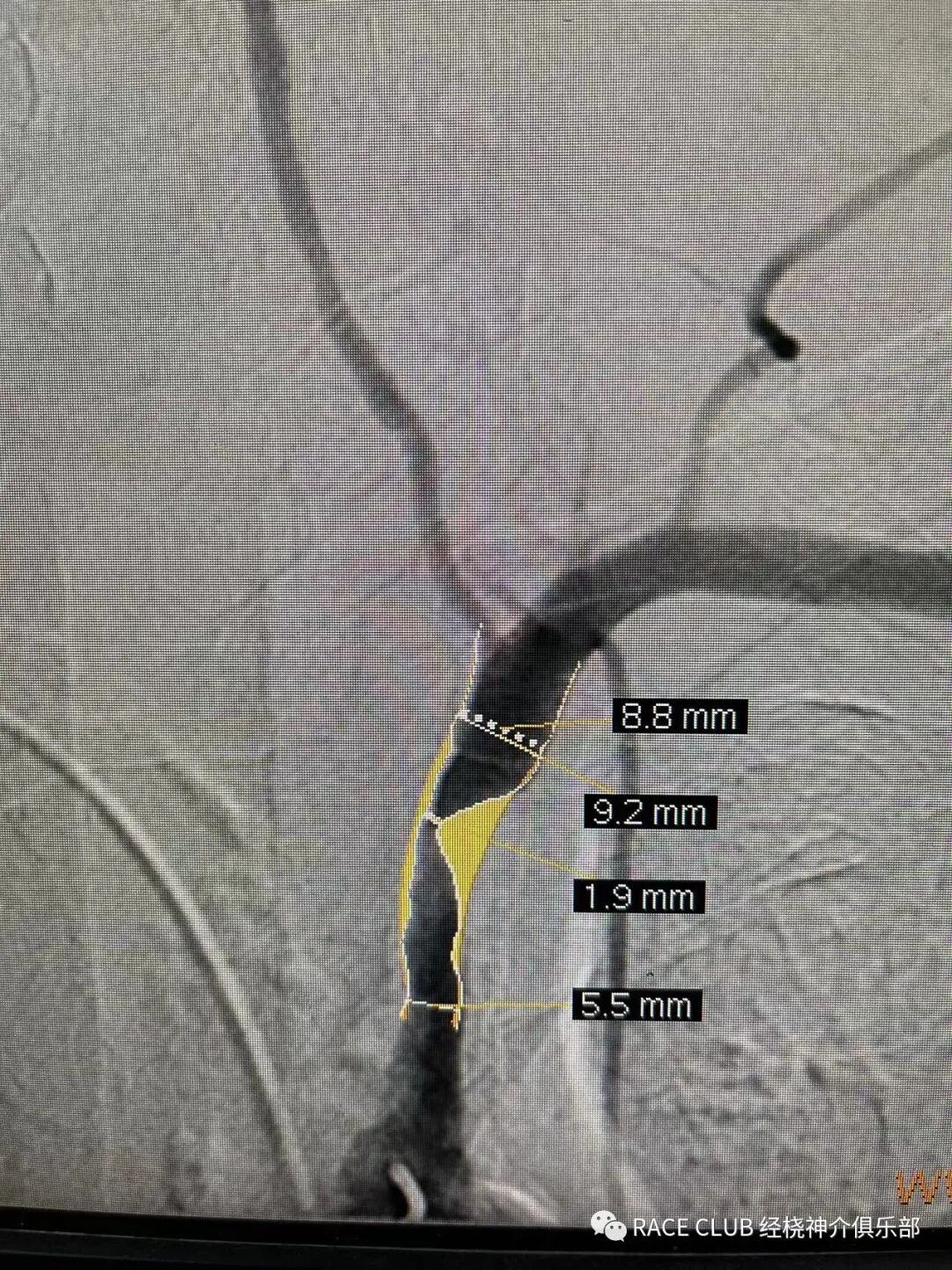 怎么上穿刺鞘RACE CLUB 实录6：Q：经桡造影或治疗，穿刺鞘如何选择？_https://www.jmylbn.com_新闻资讯_第73张