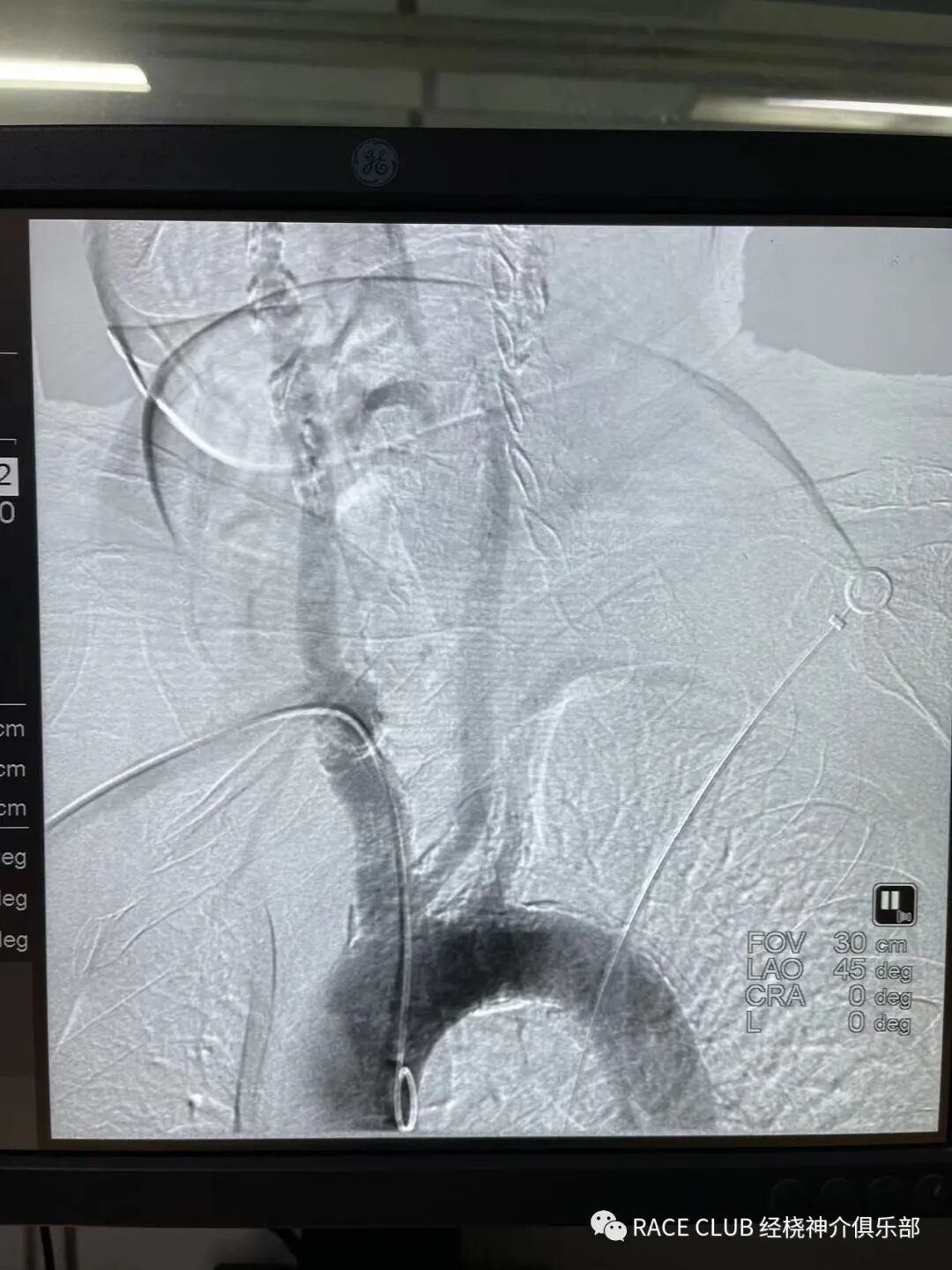 怎么上穿刺鞘RACE CLUB 实录6：Q：经桡造影或治疗，穿刺鞘如何选择？_https://www.jmylbn.com_新闻资讯_第67张