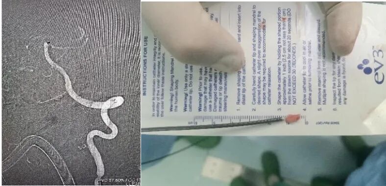 什么叫桡鞘【桡径通神】一例低NIHSS评分，基底动脉闭塞经左桡动脉取栓_https://www.jmylbn.com_新闻资讯_第14张