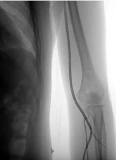 什么叫桡鞘【桡径通神】一例低NIHSS评分，基底动脉闭塞经左桡动脉取栓_https://www.jmylbn.com_新闻资讯_第12张